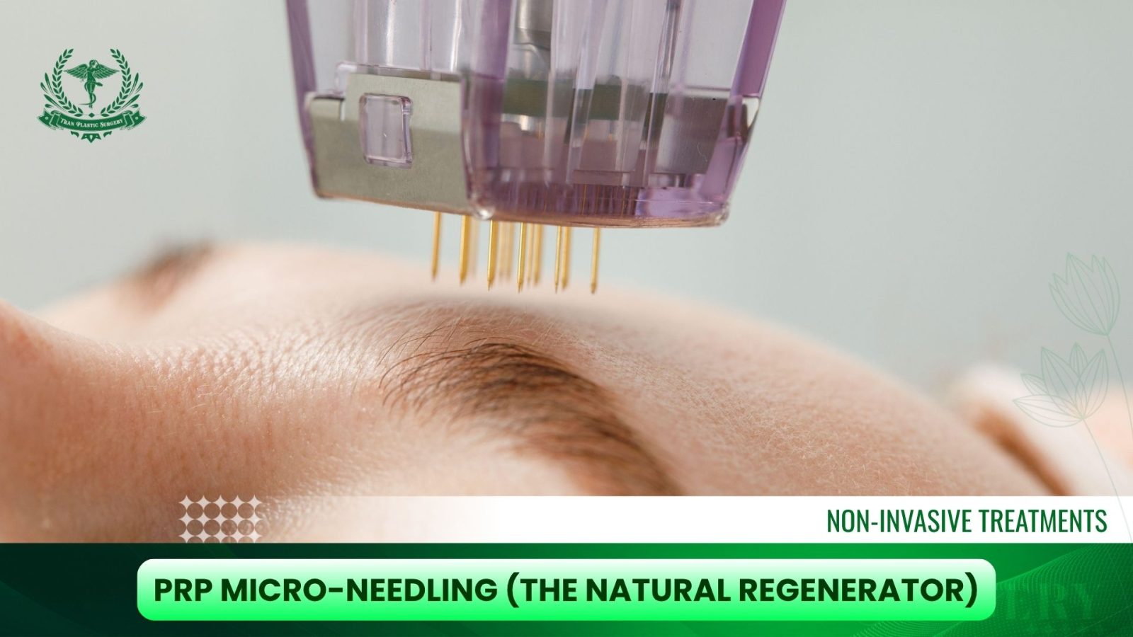PRP Micro-Needling (The Natural Regenerator)