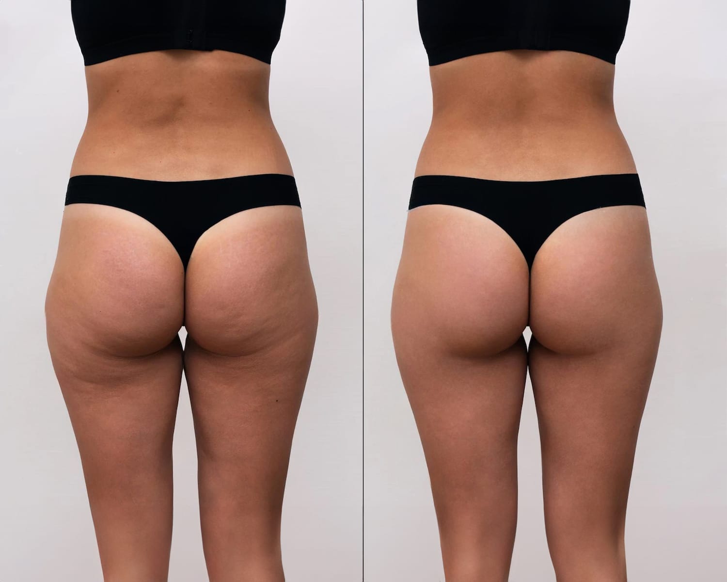 Enhance Your Curves with Butt Lift Surgery