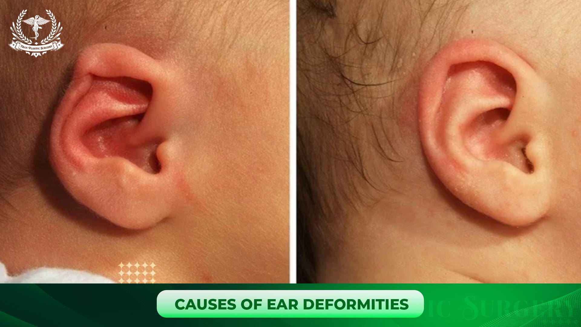 Causes of Ear Deformities
