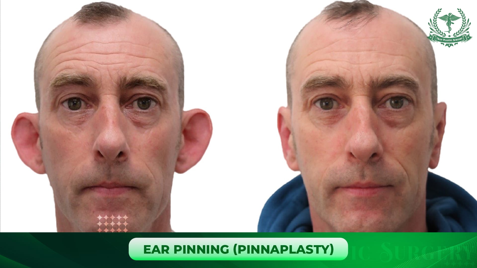 Ear Pinning (Pinnaplasty)