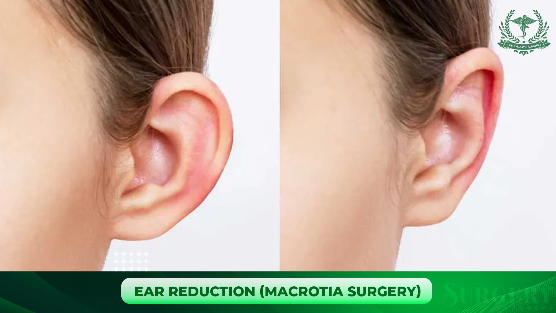 Ear Reduction (Macrotia Surgery)