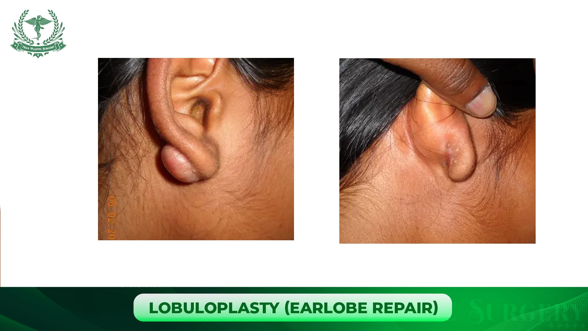 5. Lobuloplasty (Earlobe Repair)