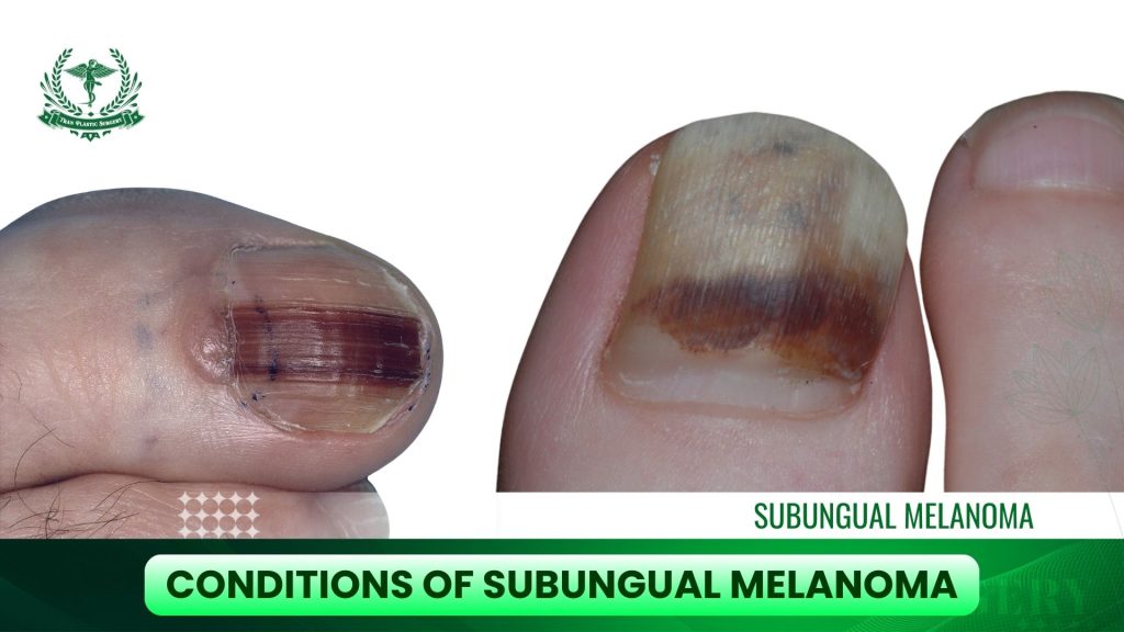 Conditions of Subungual Melanoma