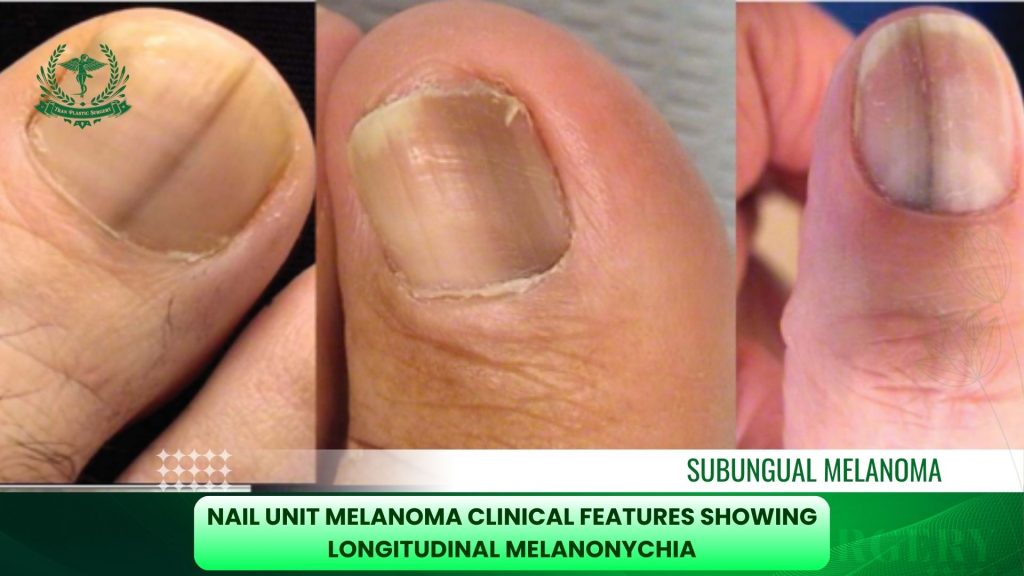 Nail unit melanoma clinical features showing longitudinal melanonychia