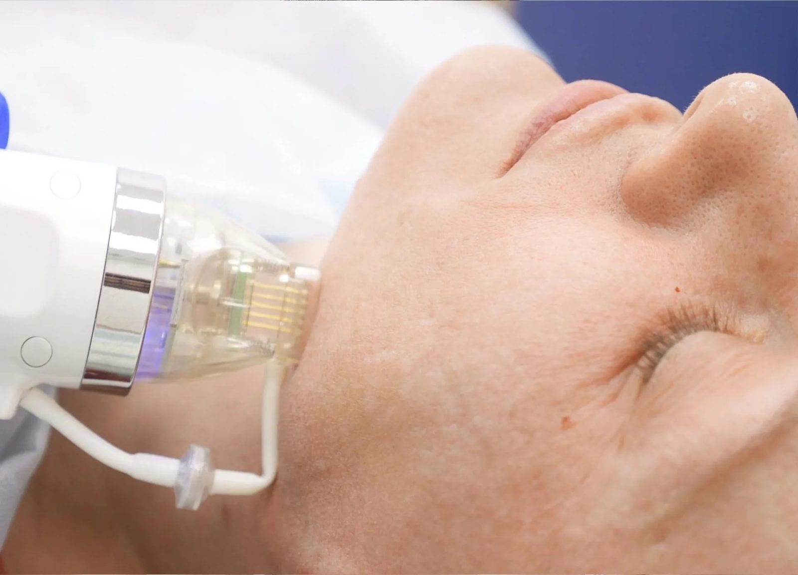 Radiofrequency Microneedling