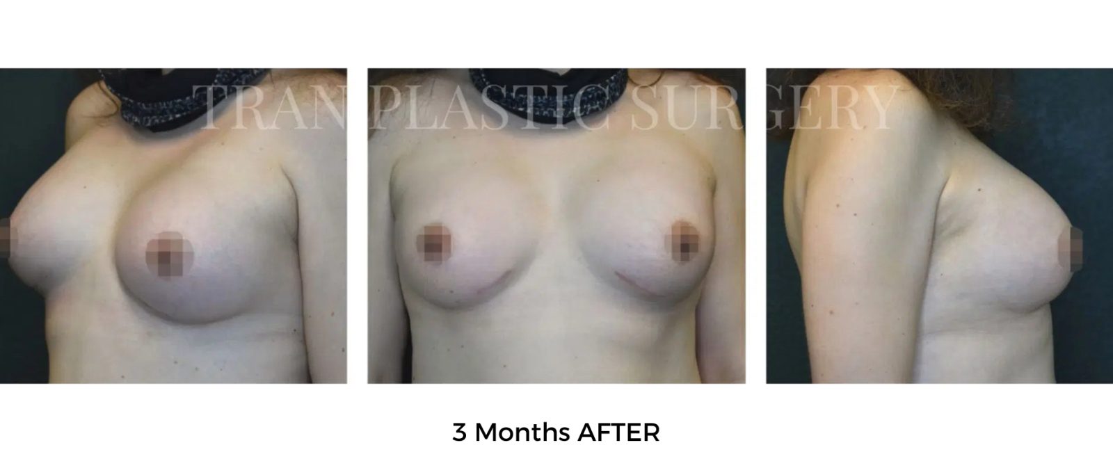 Breast After and Before | Breast Augmentation Service of Tran Plastic Surgery