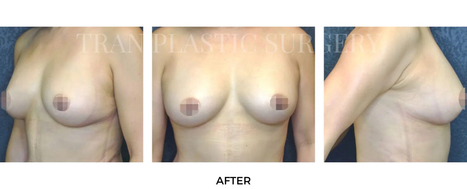 Breast After and Before | Breast Augmentation Service of Tran Plastic Surgery