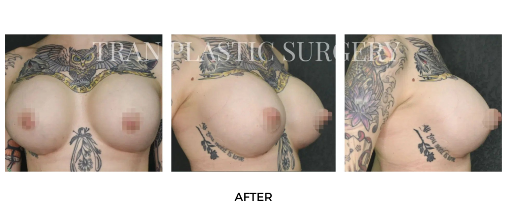 Breast Lift Service at Tran Plastic Surgery