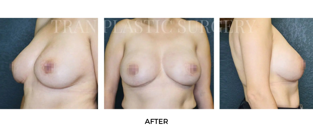 Breast Lift Service at Tran Plastic Surgery