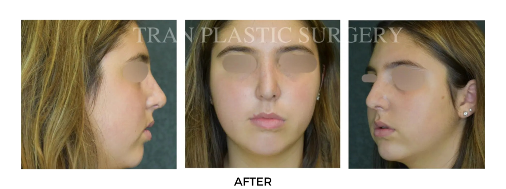 After brow lift surgery results showing lifted brows and smoother forehead at Tran Plastic Surgery