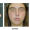 After brow lift surgery results showing lifted brows and smoother forehead at Tran Plastic Surgery