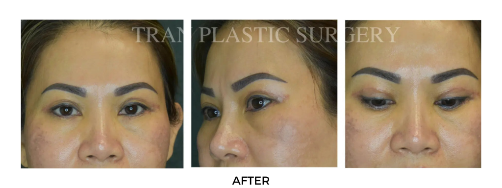 After brow lift surgery results showing lifted brows and smoother forehead at Tran Plastic Surgery