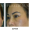 After brow lift surgery results showing lifted brows and smoother forehead at Tran Plastic Surgery