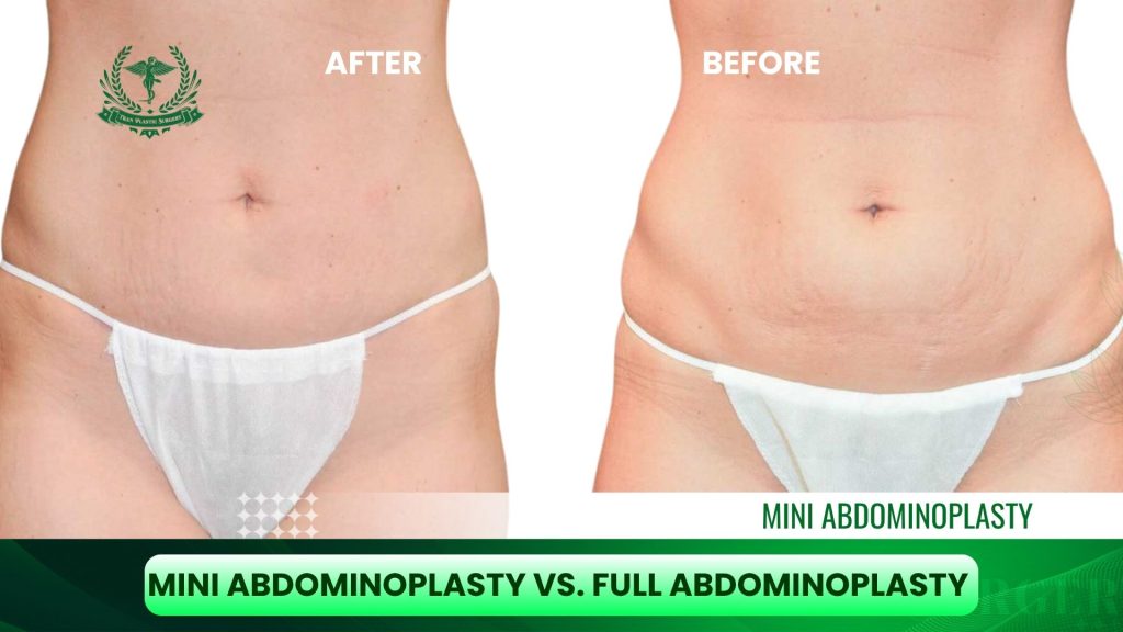 Mini Abdominoplasty vs. Full Abdominoplasty