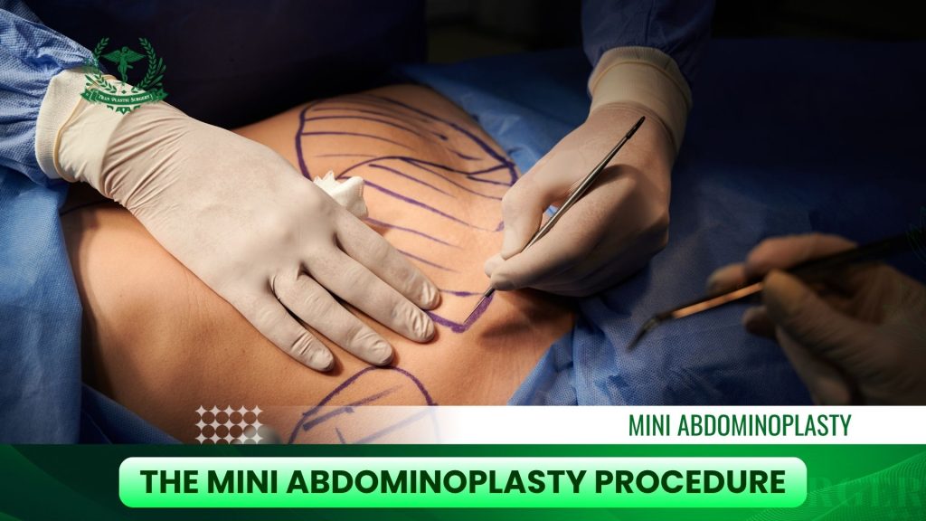 The Mini Abdominoplasty Procedure