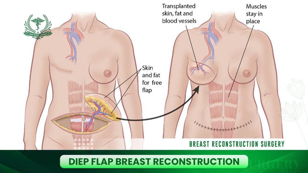 DIEP Flap Breast Reconstruction