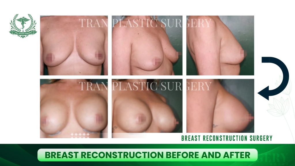 Breast Reconstruction Before and After