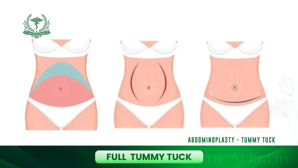 Full Tummy Tuck (Traditional Abdominoplasty)