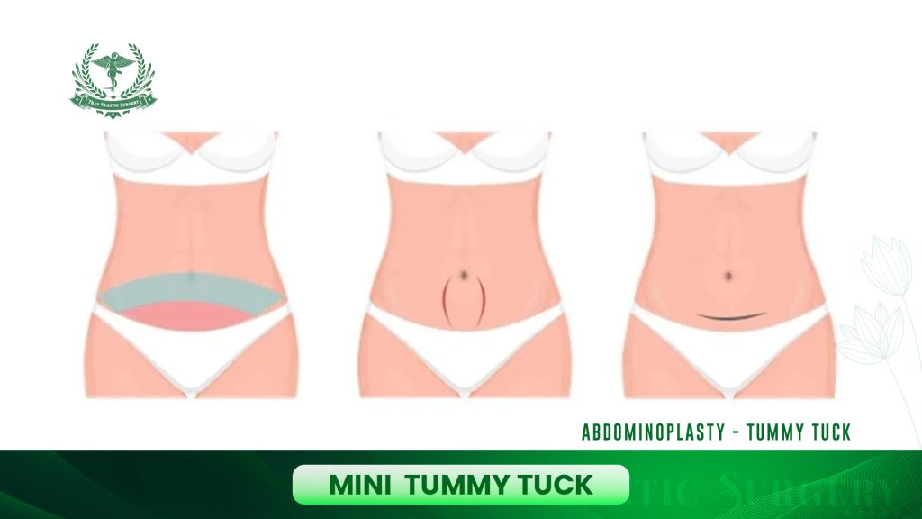 Mini Tummy Tuck (Partial Abdominoplasty)