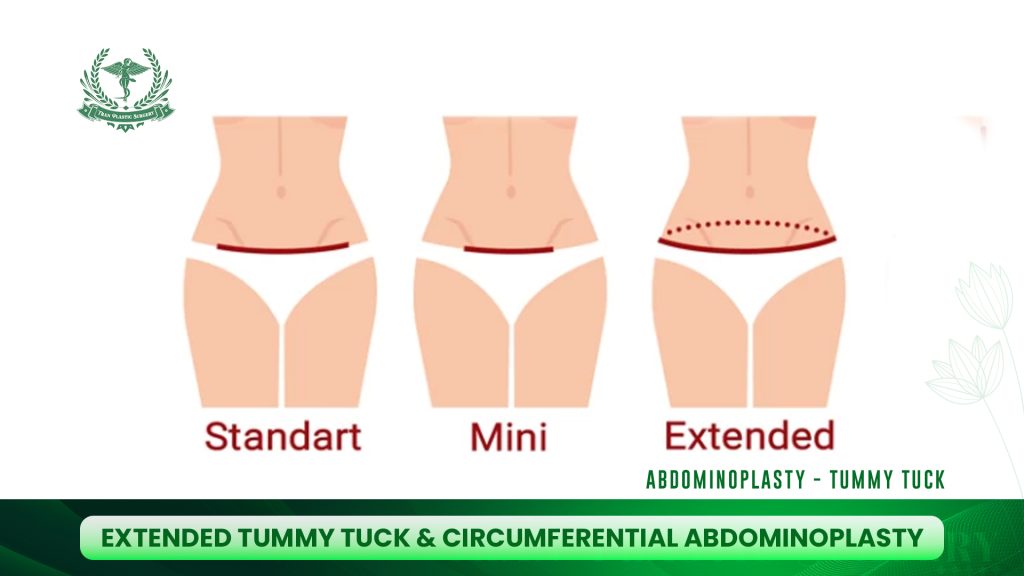 Extended Tummy Tuck & Circumferential Abdominoplasty