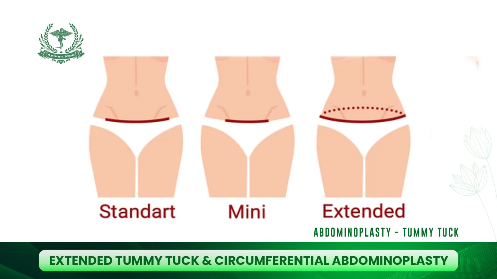 Extended Tummy Tuck & Circumferential Abdominoplasty