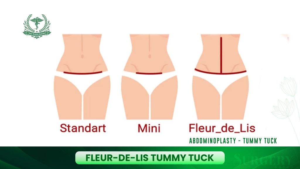 Fleur-de-Lis Tummy Tuck