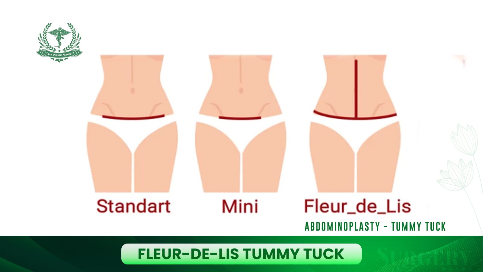 Fleur-de-Lis Tummy Tuck