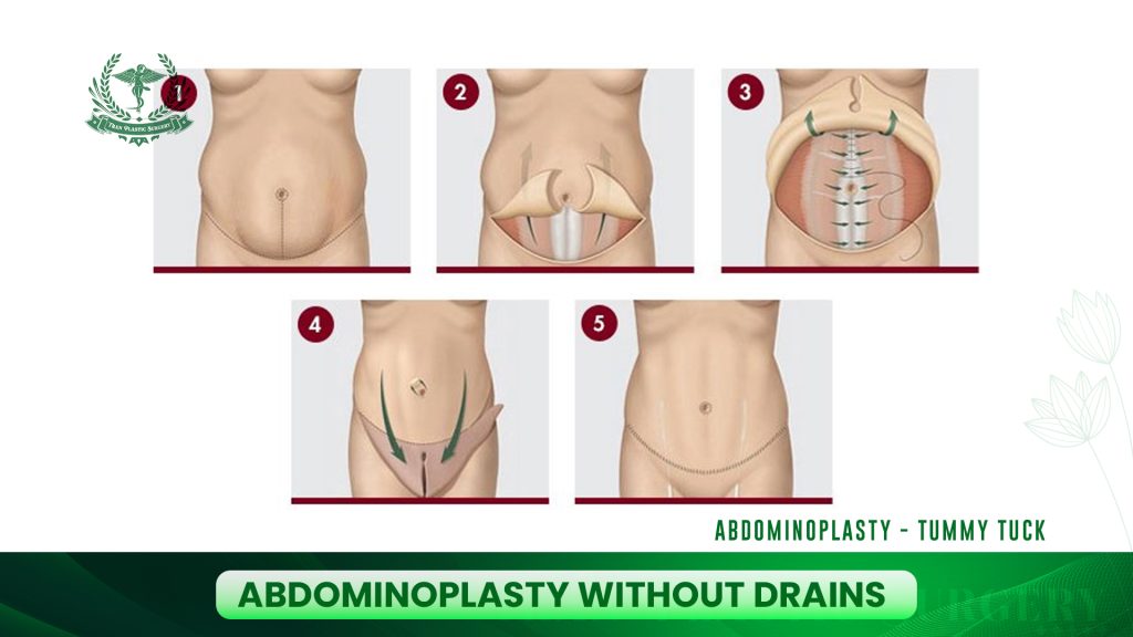 Abdominoplasty without Drains