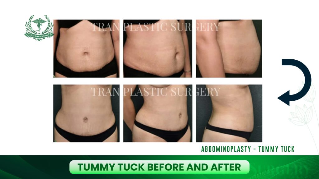 Tummy Tuck Before and After
