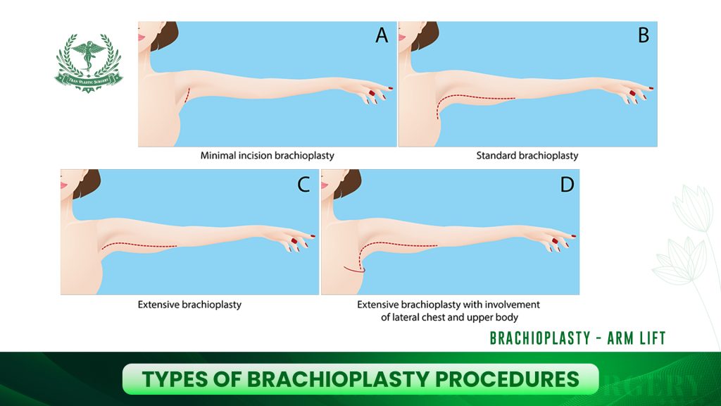 Types of Brachioplasty Procedures