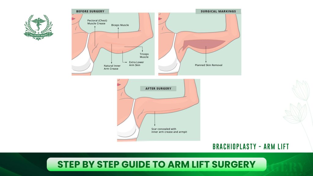 Step by Step Guide to Arm Lift Surgery