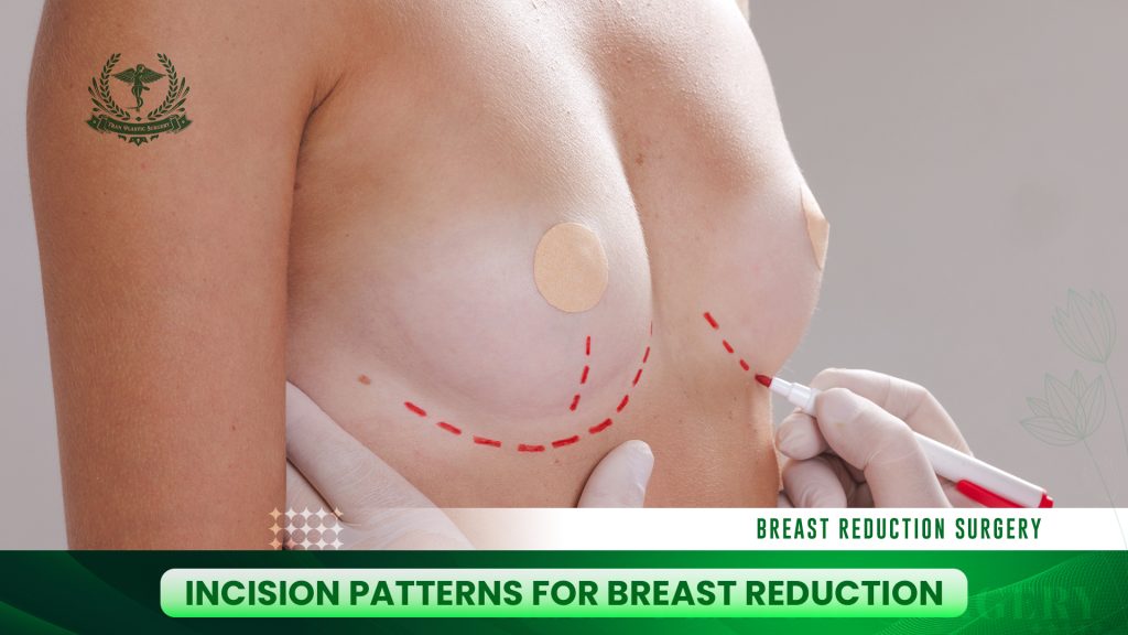 Incision Patterns for Breast Reduction