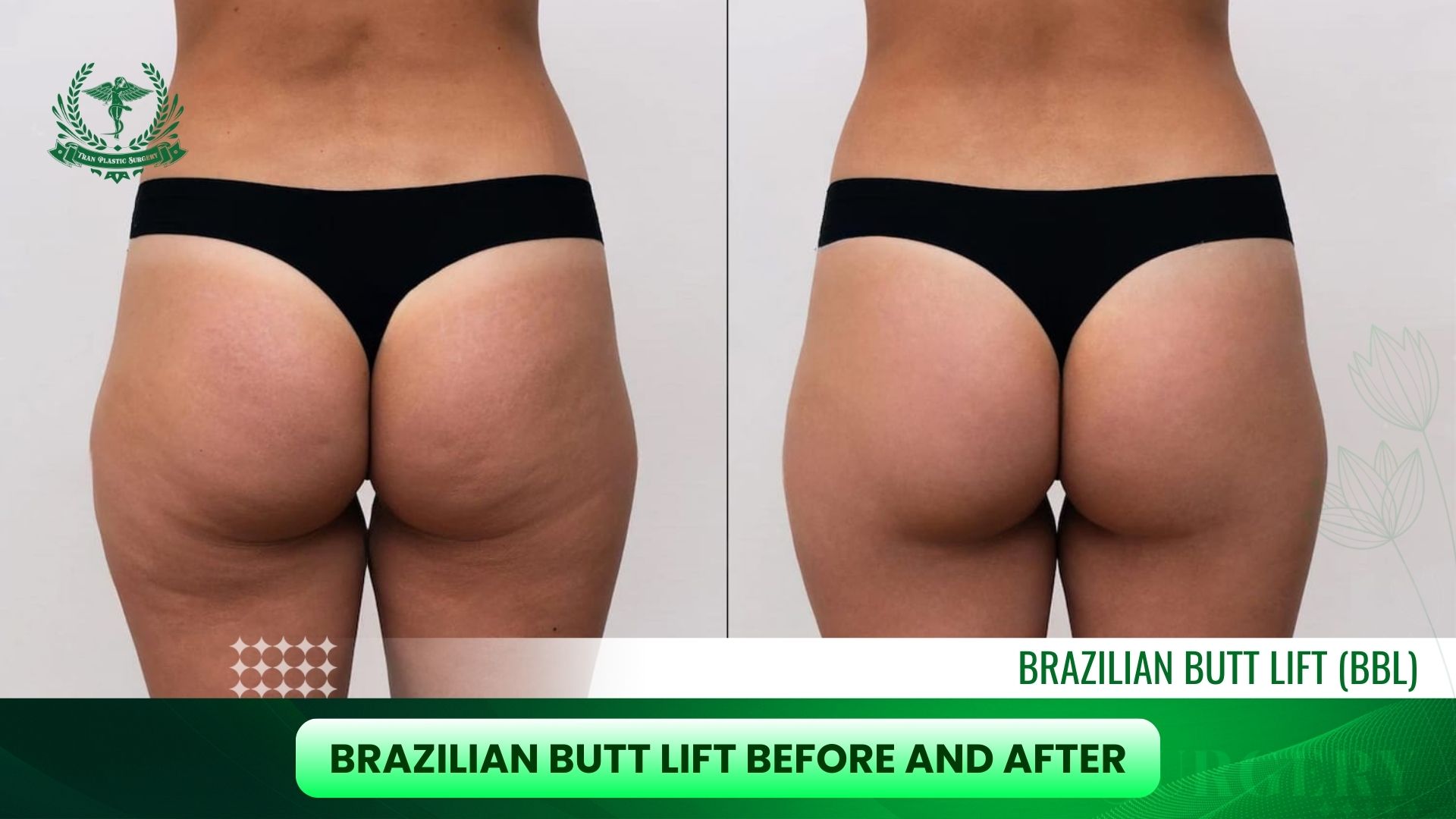 Brazilian Butt Lift Before and After 