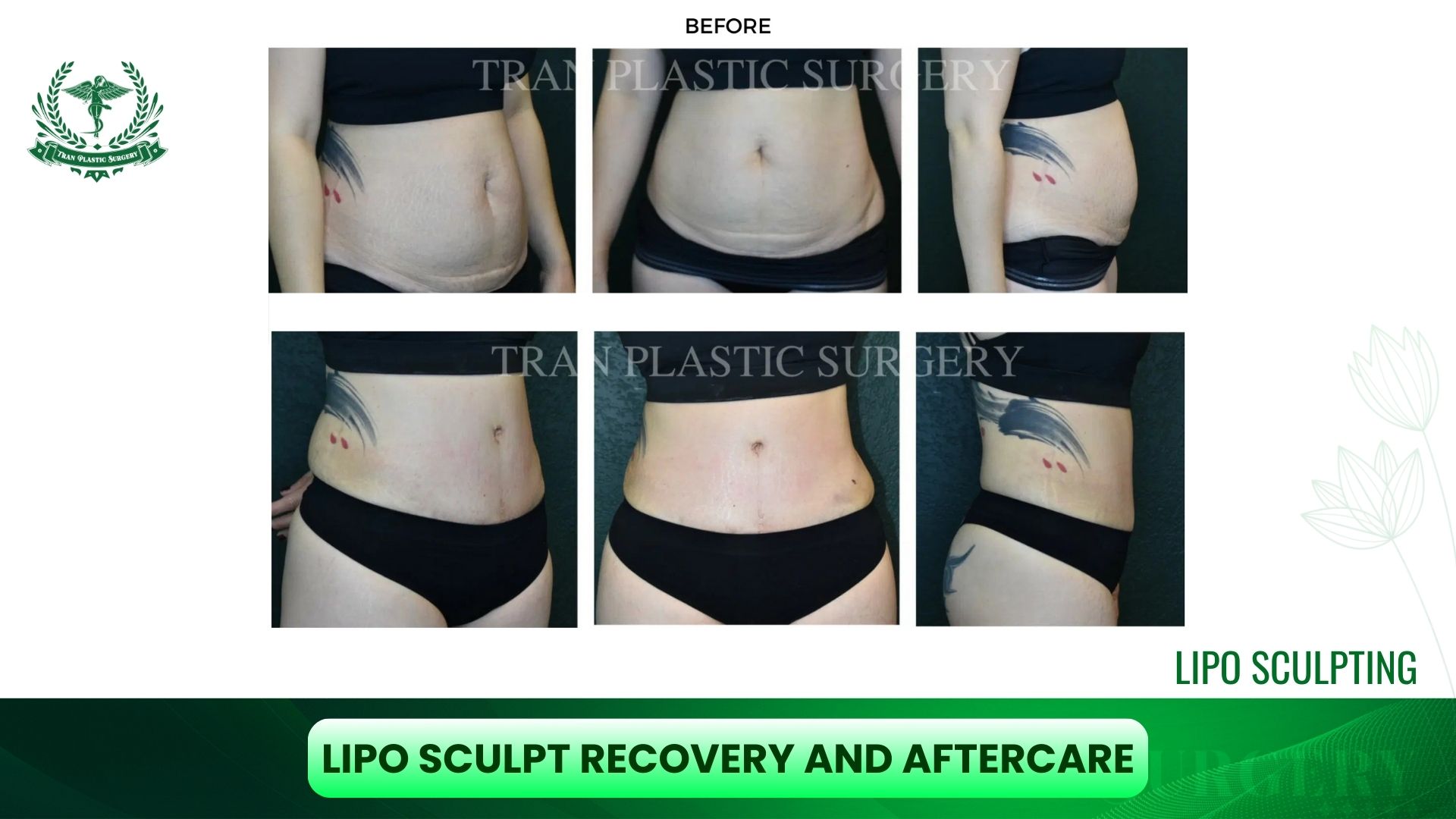 Lipo Sculpt Recovery and Aftercare 01