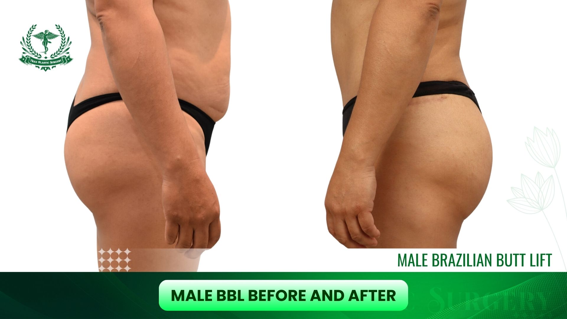 Male BBL Before and After