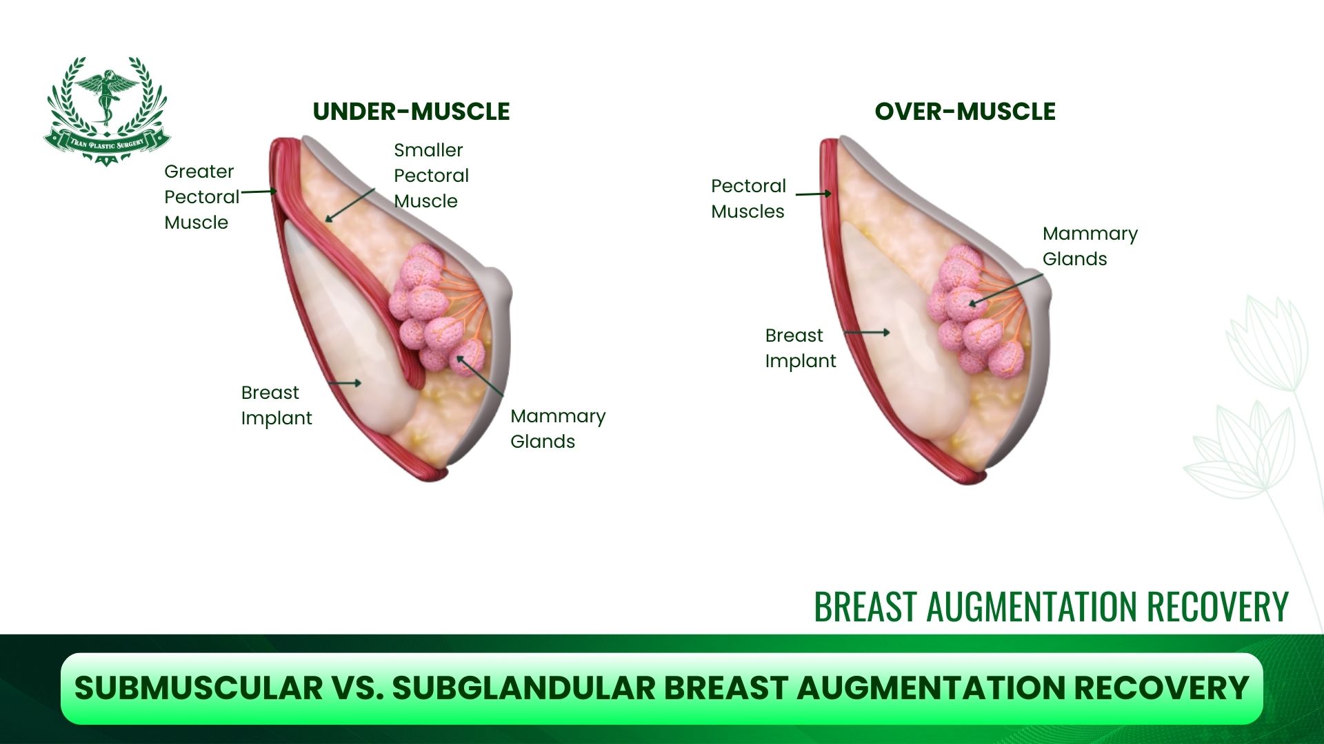 Submuscular vs. Subglandular Breast Augmentation Recovery