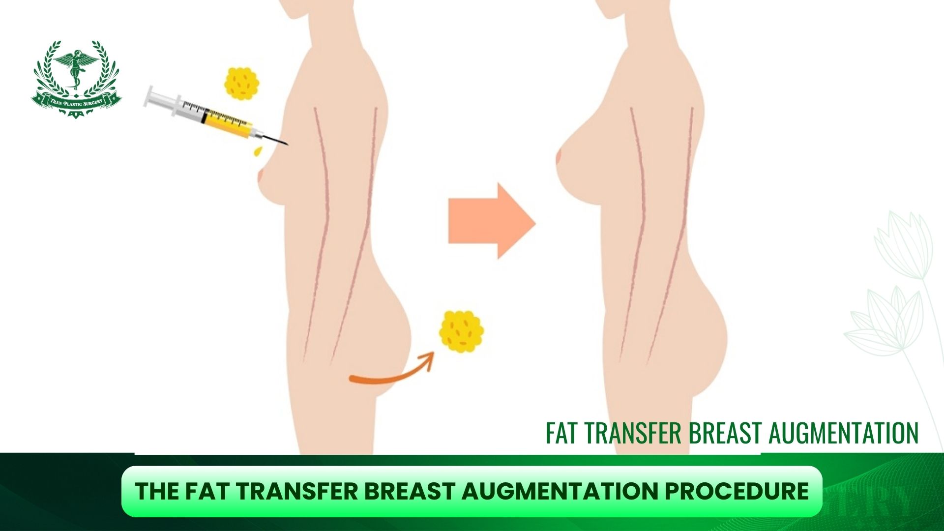 The Fat Transfer Breast Augmentation Procedure