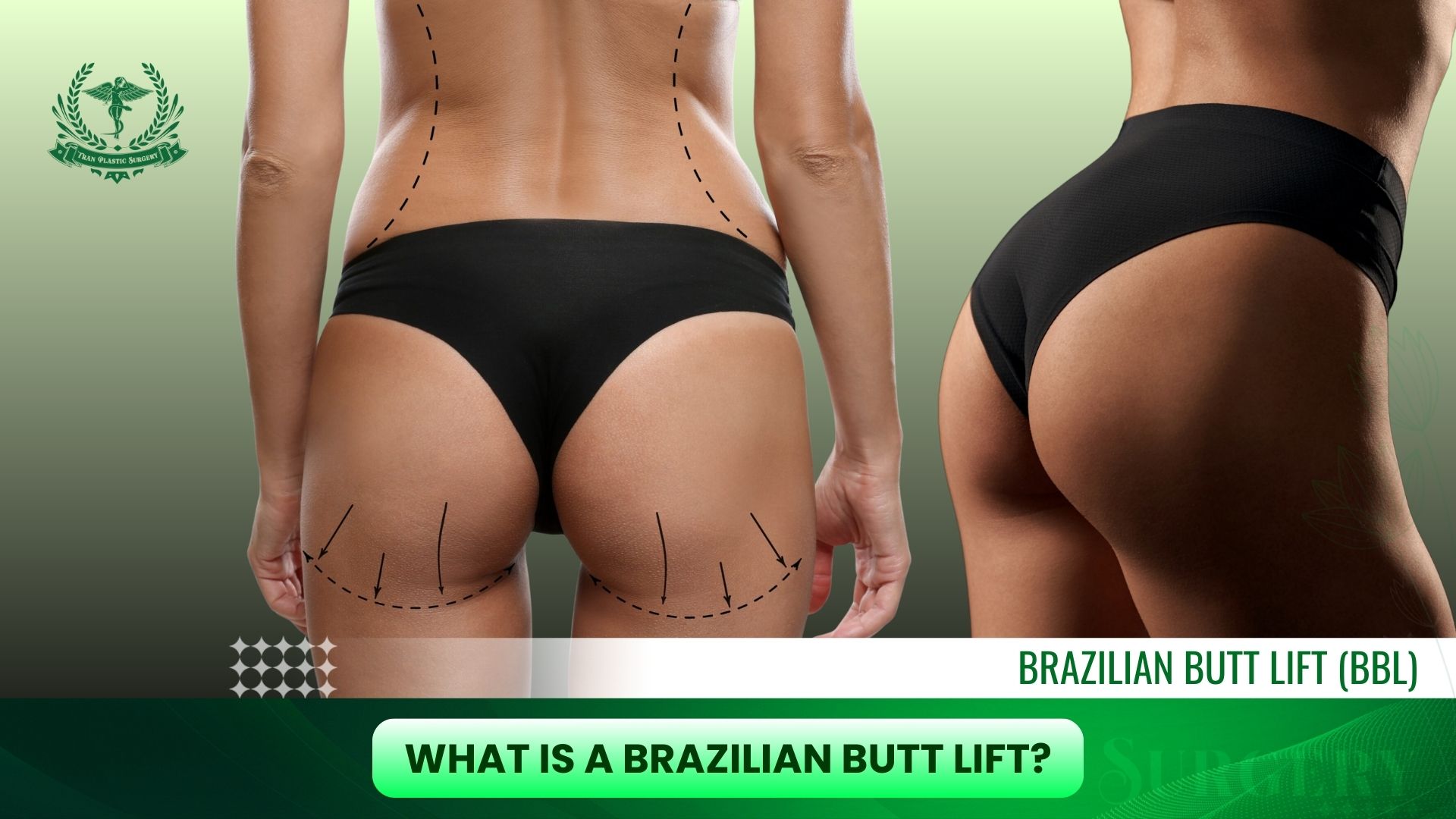 What Is a Brazilian Butt Lift