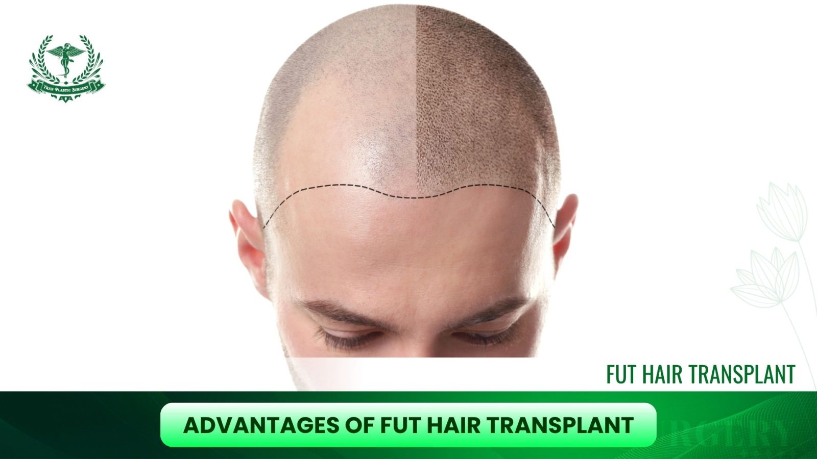 Advantages of FUT Hair Transplant