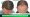 Results of Hair Restoration Surgery - Before and After