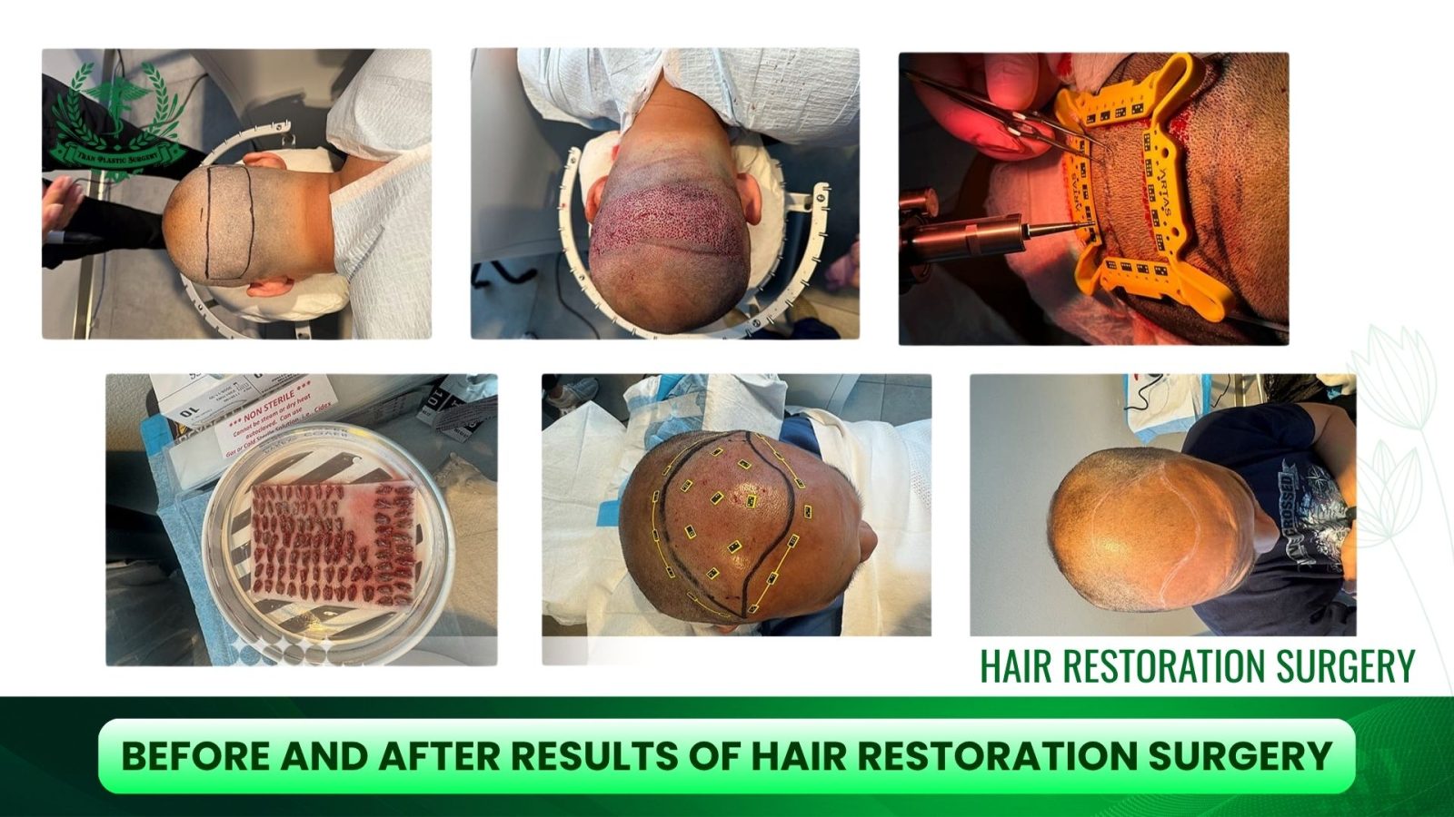 Before and After Results of Hair Restoration Surgery