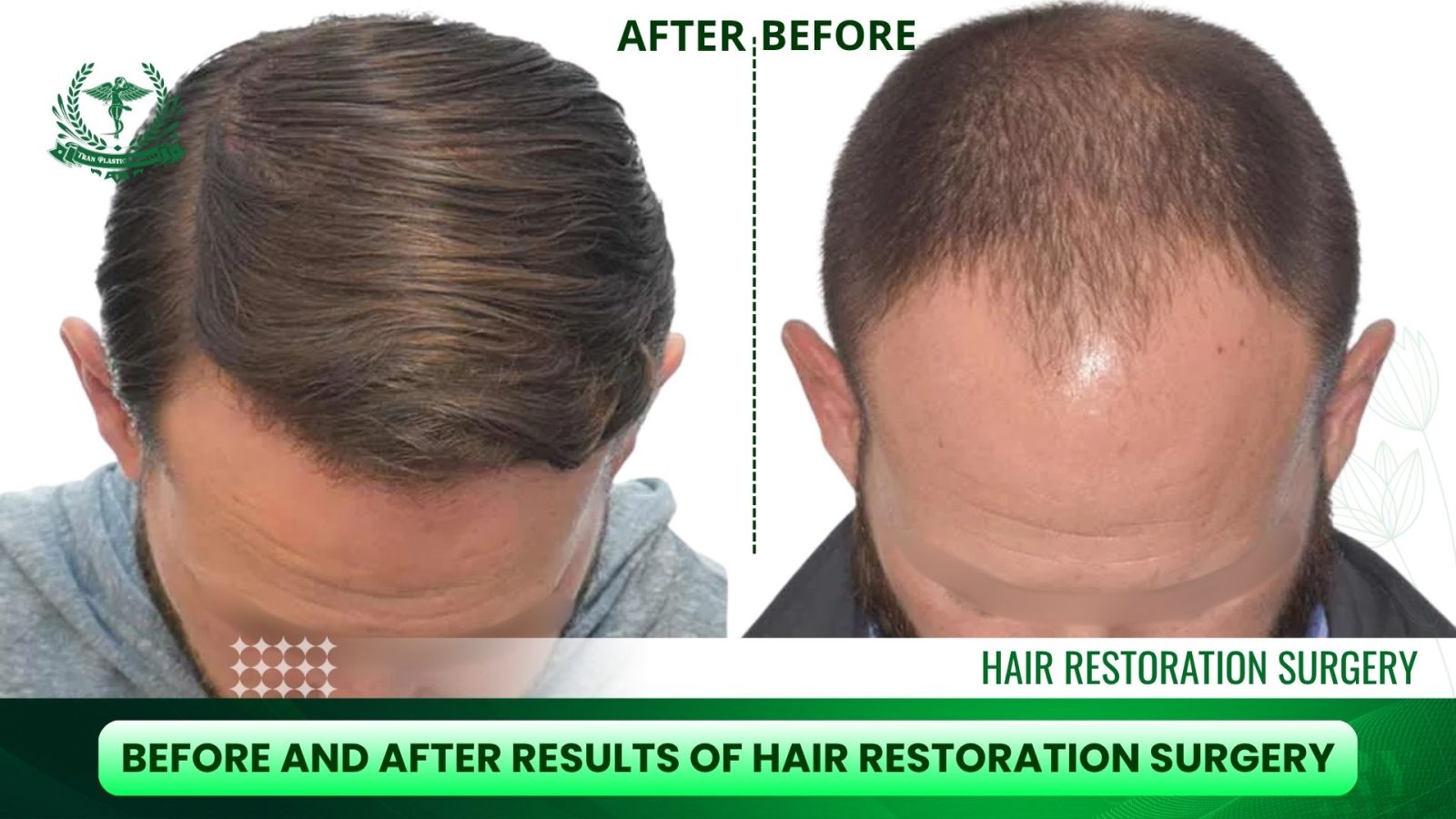 Results of Hair Restoration Surgery - Before and After