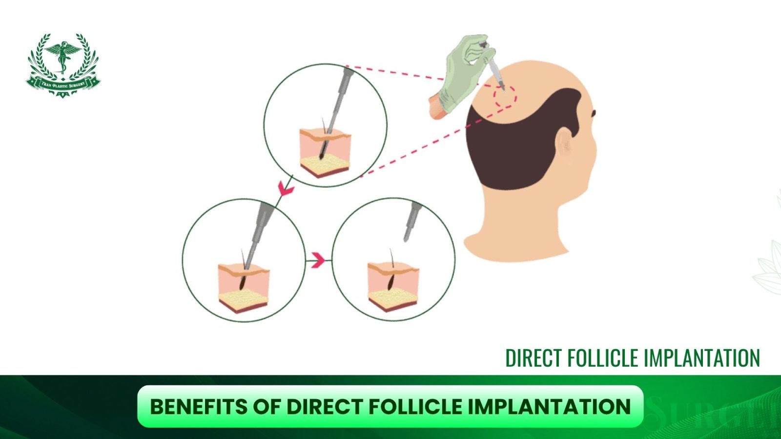 Benefits of Direct Follicle Implantation