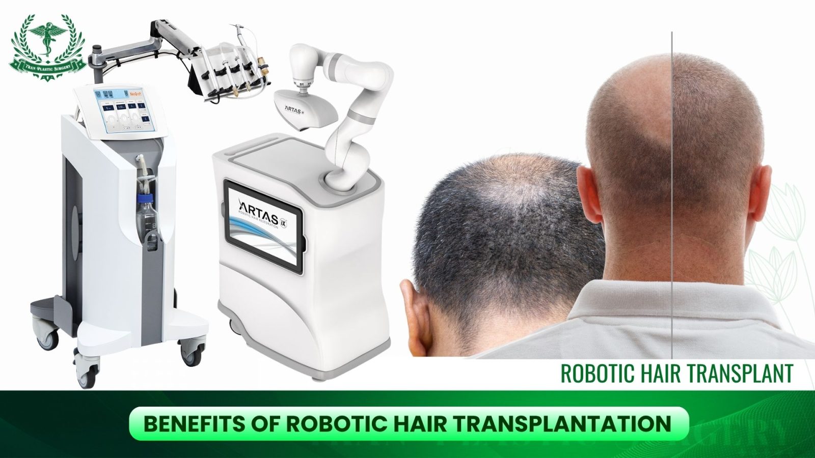 Benefits of Robotic Hair Transplantation