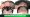 DHI Hair Transplant Before and After Results