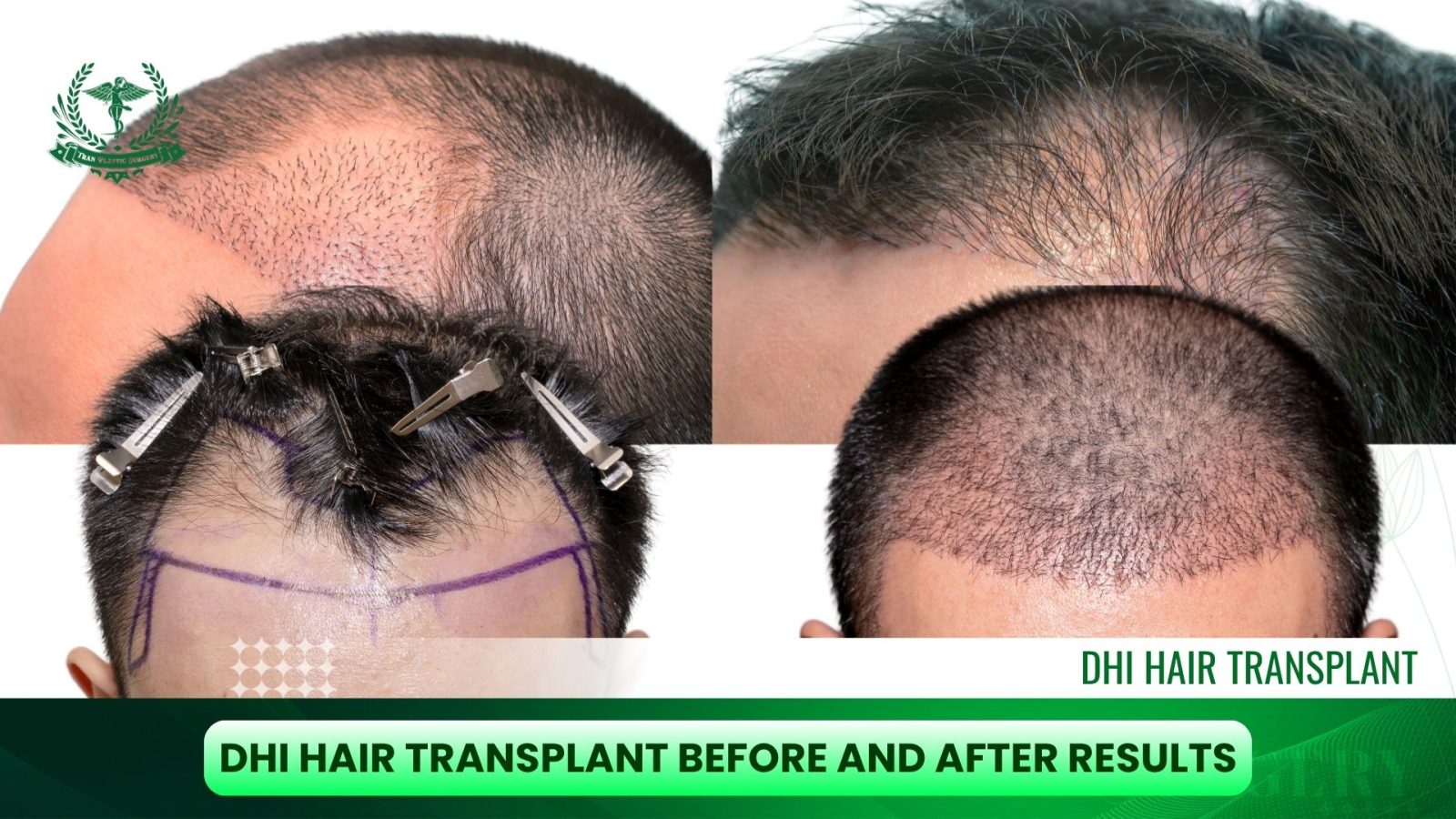 DHI Hair Transplant Before and After Results