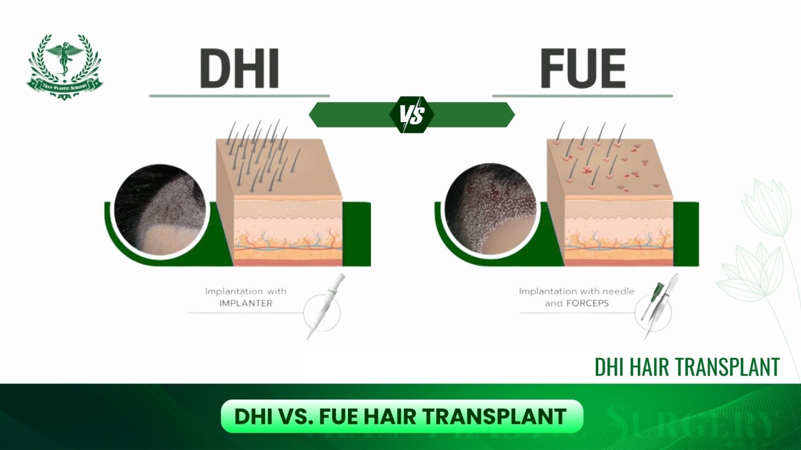 DHI vs. FUE - Which Technique Is Best?