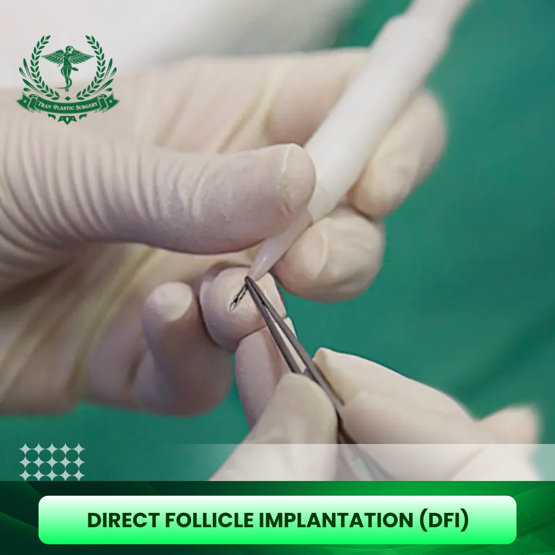 Direct Follicle Implantation (DFI)