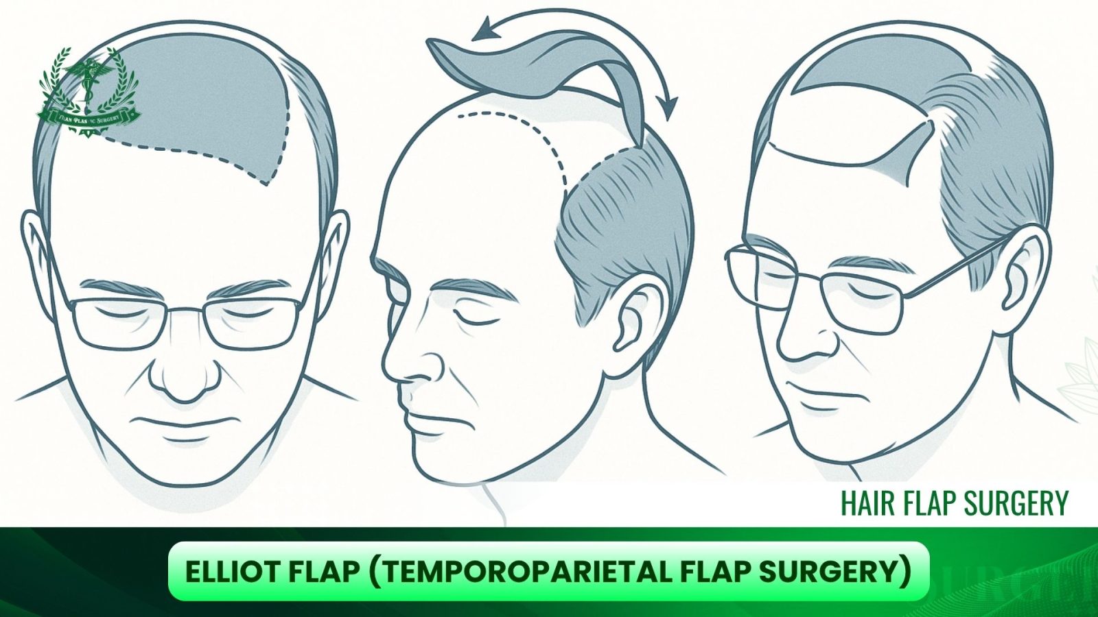 Elliot Flap (Temporoparietal Flap Surgery)