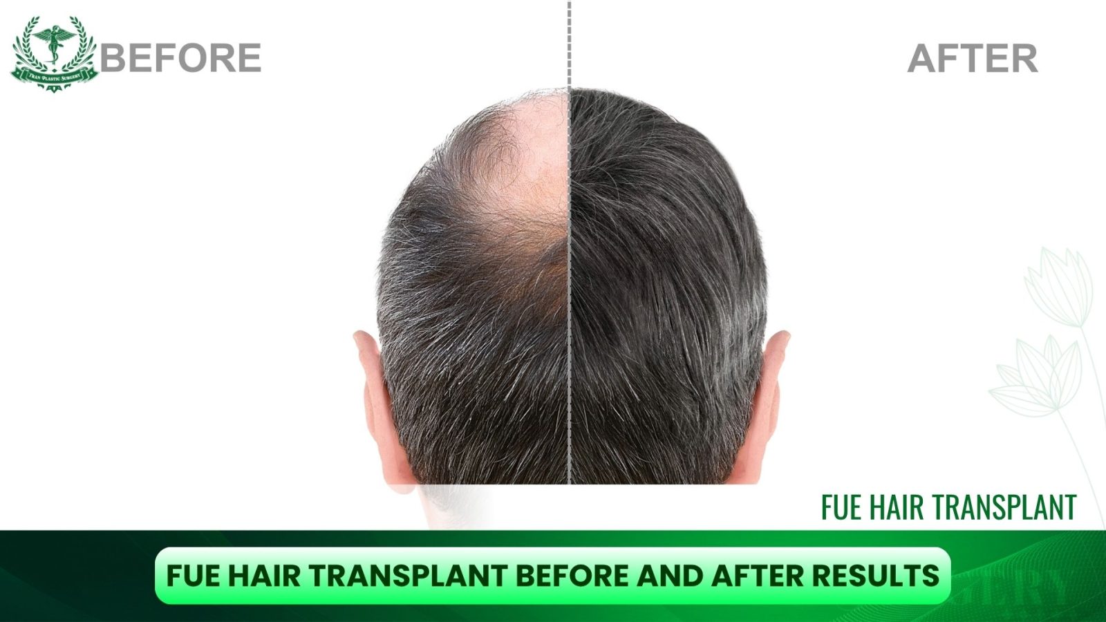 FUE Hair Transplant Before and After Results